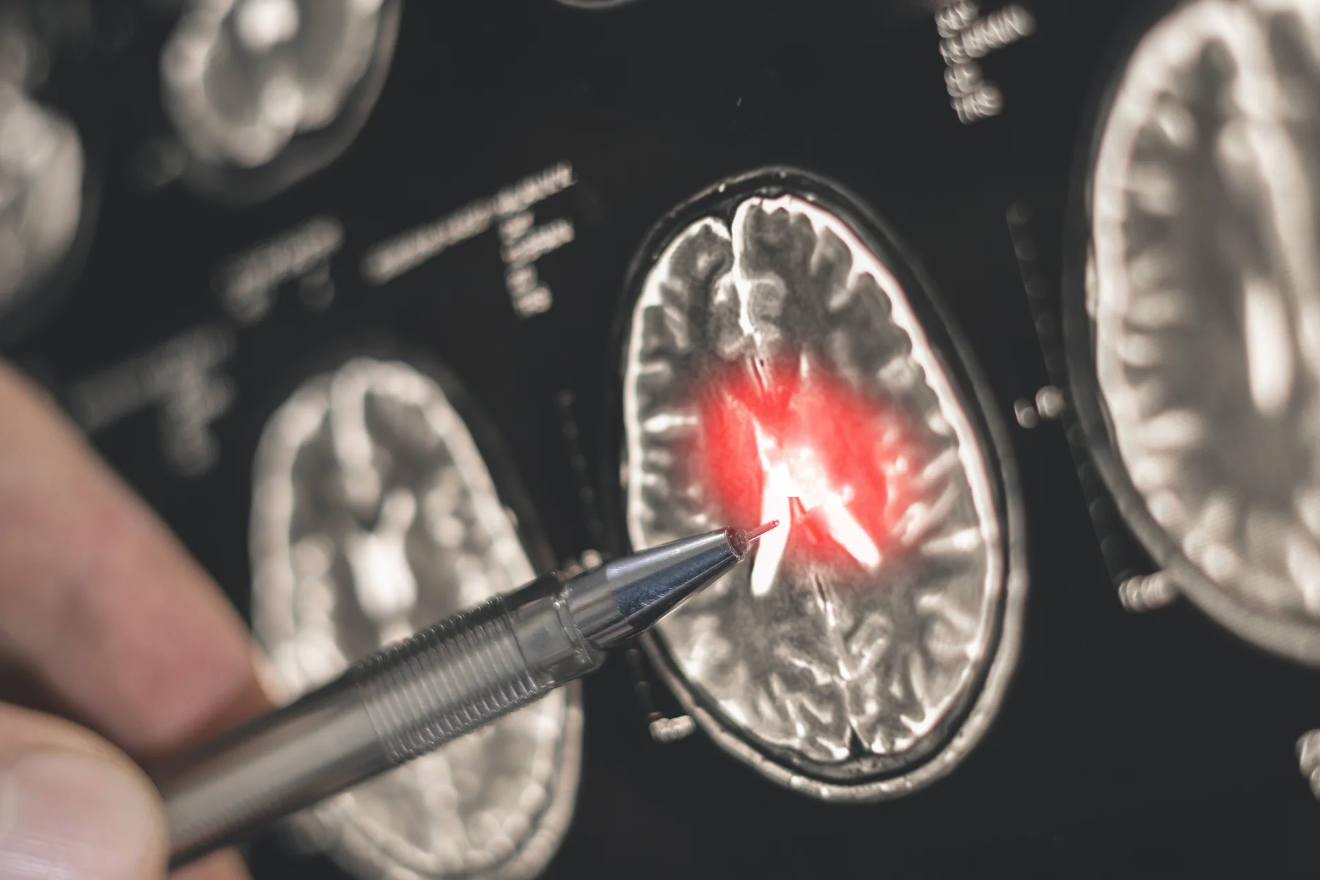 Confirmed Parkinson's Diagnosis